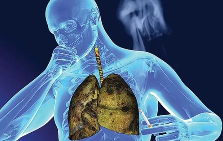 Phát triển thiết bị LoC hỗ trợ phát hiện sớm tế bào ung thư phổi - Ảnh 1.